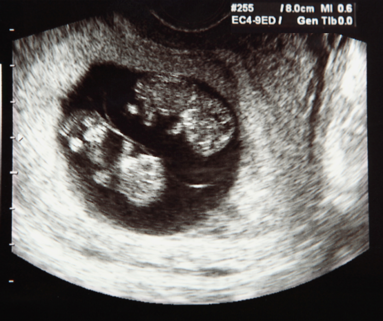 Image of twin ultrasound